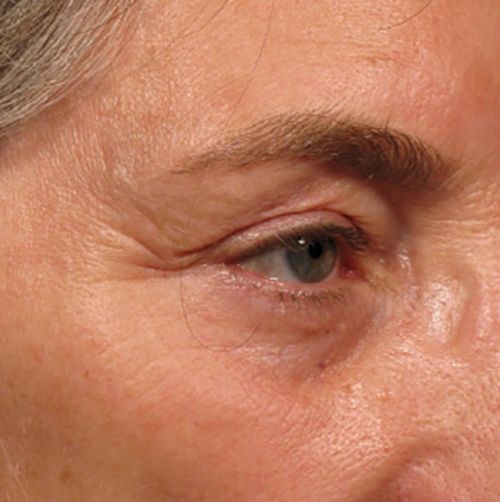 Ultherapy despues Ultherapy después
