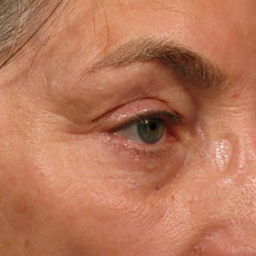 Ultherapy despues Ultherapy después