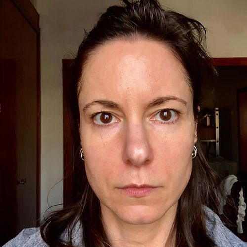 despues Morpheus 8. Radiofrecuencia para reducir la flacidez facial Después Morpheus 8. Radiofrecuencia para reducir la flacidez facial
