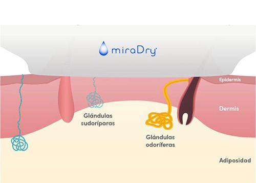 MIRADRY exceso de sudoración axilar
