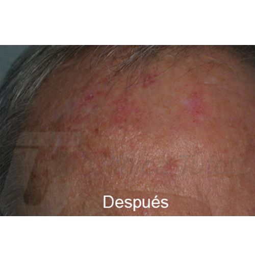 queratosis actínica clinica tufet