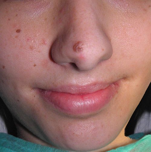 tratamiento lunares o nevus dermatologia clinica tufet barcelona