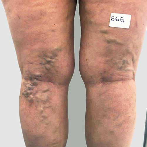 boutique_37 ESCLEROSIS DE VARICES