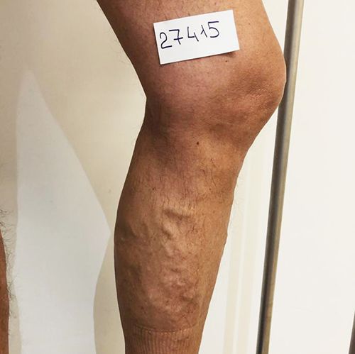 boutique_37 ESCLEROSIS DE VARICES