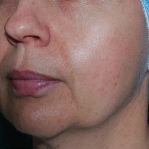 morpheus 8 flacidez facial barcelona