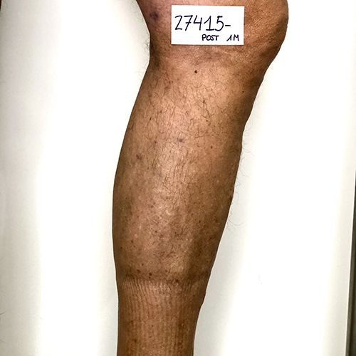 boutique_37 ESCLEROSIS DE VARICES