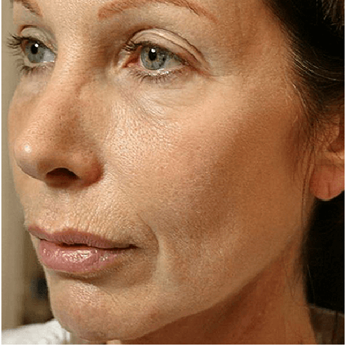 thermage flx flacidez facial