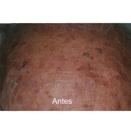 queratosis actínica clinica tufet