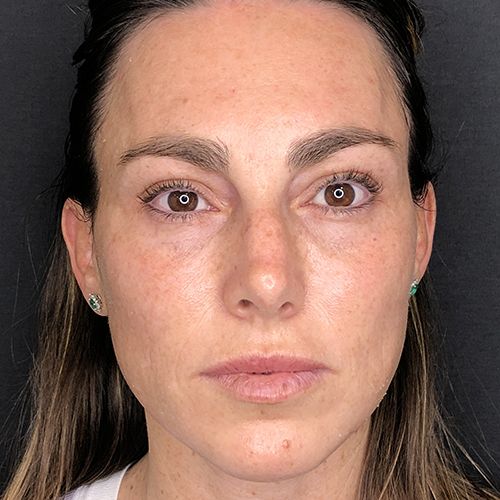 hydrafacial limpieza facial profunda barcelona