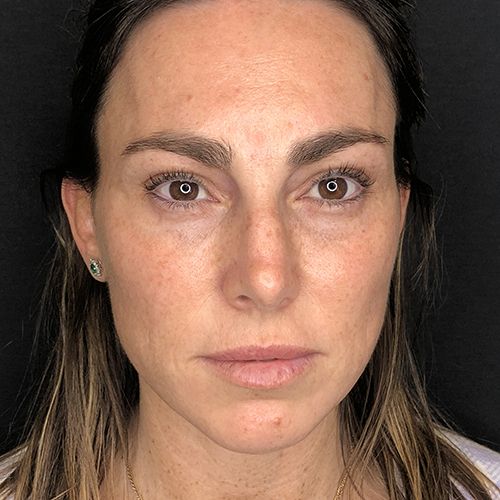 hydrafacial limpieza facial profunda barcelona