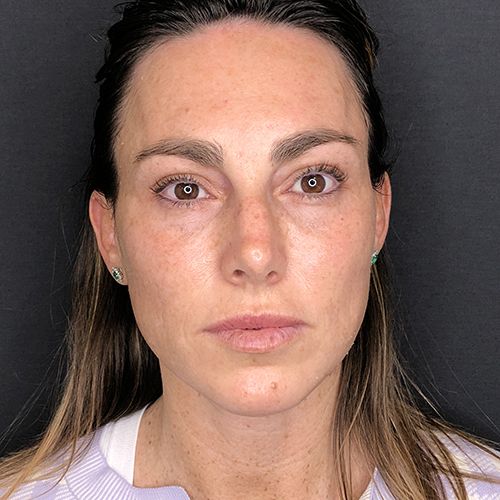 hydrafacial limpieza facial profunda barcelona