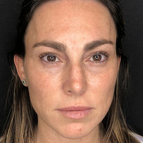 hydrafacial limpieza facial profunda barcelona