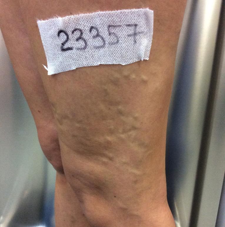 boutique_37 varices antes caso 5