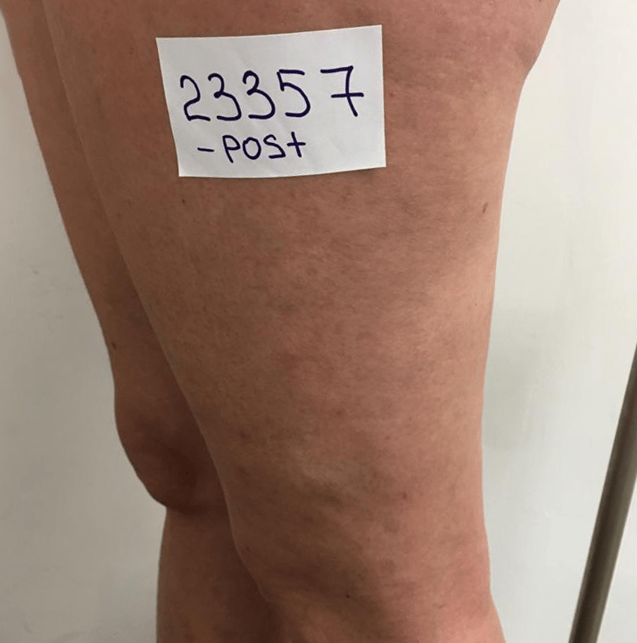 boutique_37 varices antes caso 5