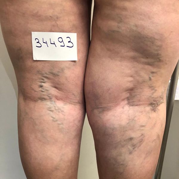 boutique_37 despues escleroterapia de venas clinica tufet