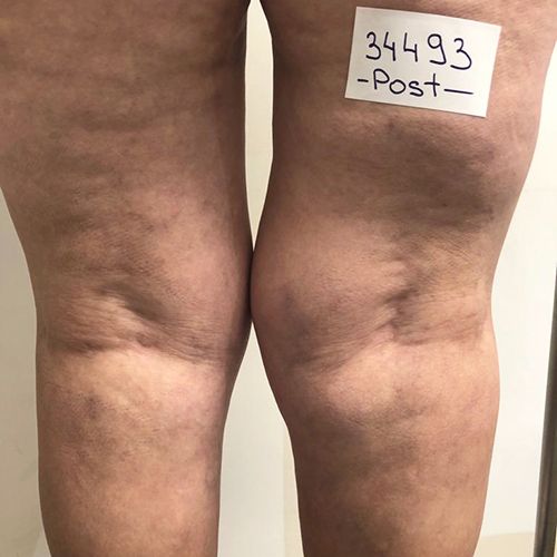 boutique_37 despues escleroterapia de venas clinica tufet
