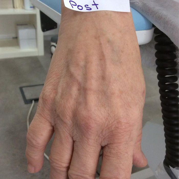 venas en las mano dr. carlos bone clinica tufet venas en las manos clinica tufet