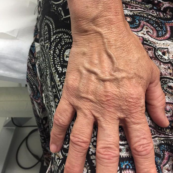 venas en las mano dr. carlos bone clinica tufet venas en las manos clinica tufet