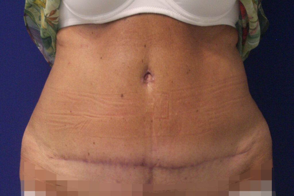 abdominoplastias