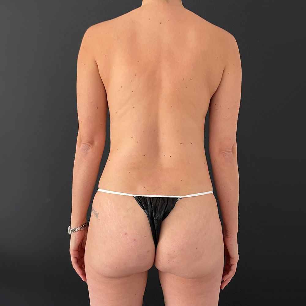despues crioconcept 1 criolipolisis barcelona