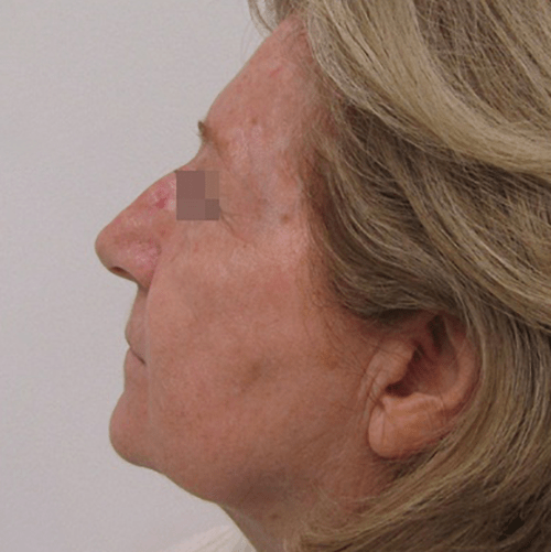 antes despues laser co2 clinica tufet