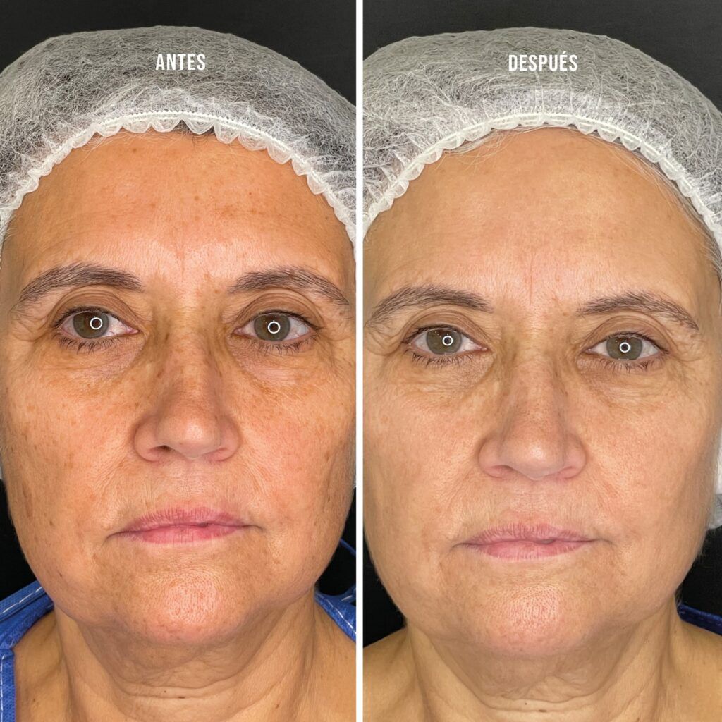 IPL spot treatment to remove blemishes on the face