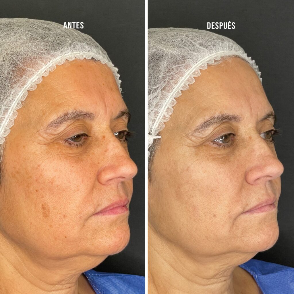 IPL spot treatment