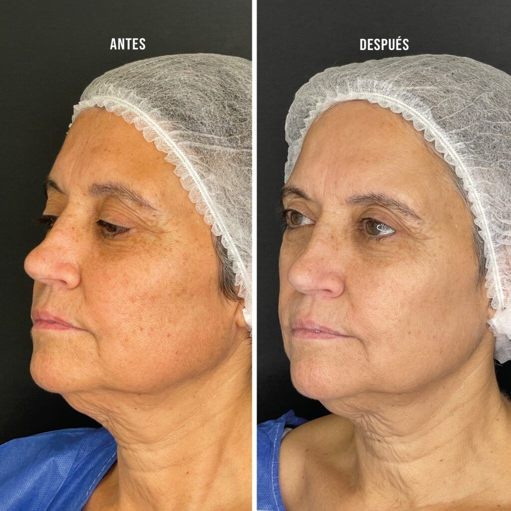 IPL spot treatment