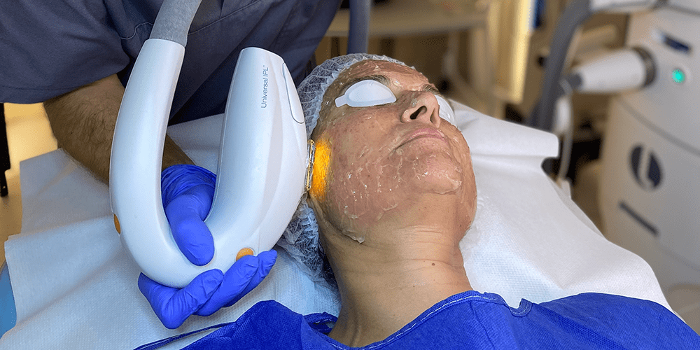 Luz Pulsada IPL Facial, Eliminación De Manchas