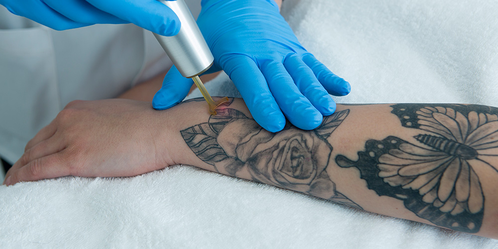 eliminación de tatuajes con láser picosegundos