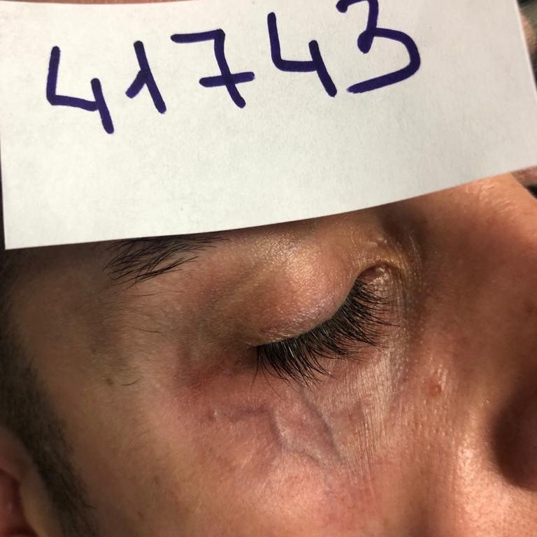despues tratamiento varices parpados