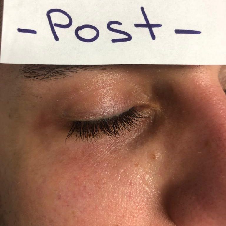 despues tratamiento varices parpados