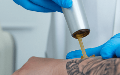 10 consejos para la eliminación de tatuajes