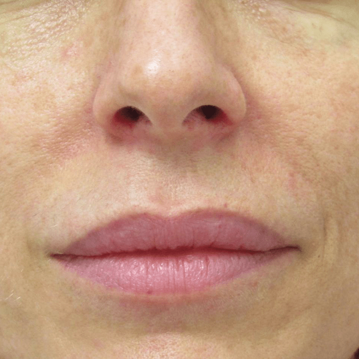 despues aumento de labios antes aumento de labios
