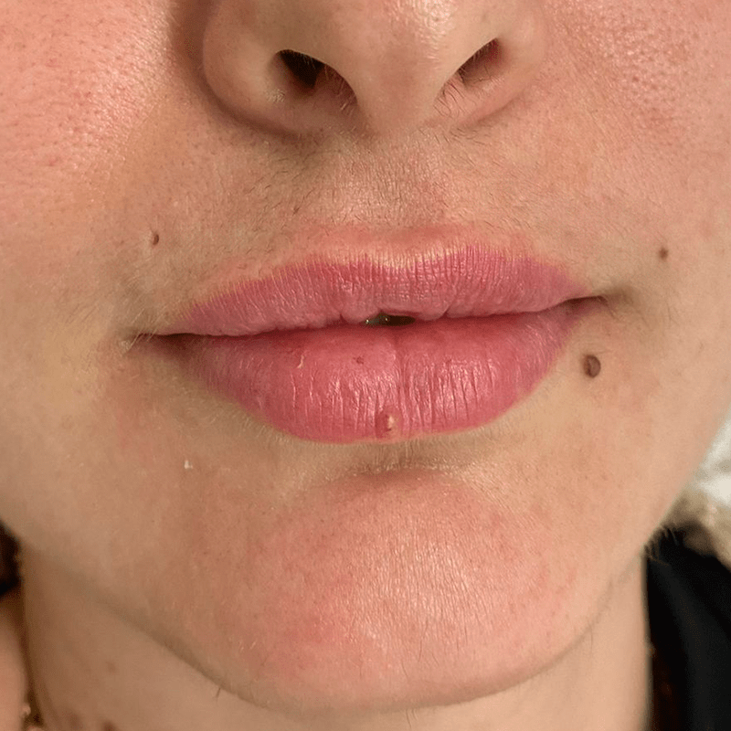 despues labios aumento labios