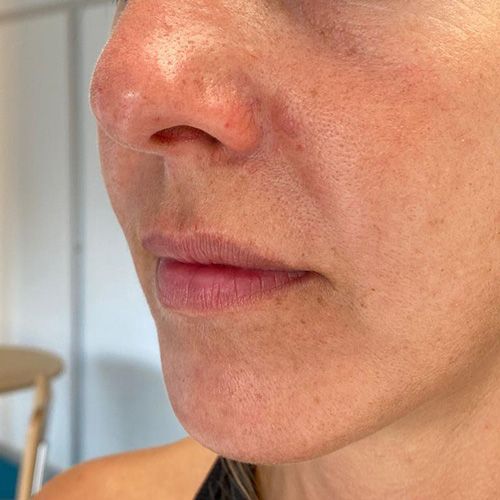 aumento de labios con acido hialuronico clinicatufet aumento de labios con acido hialuronico clinica tufet
