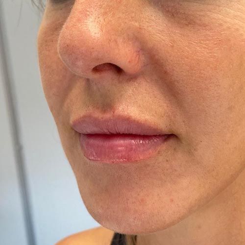 aumento de labios con acido hialuronico clinicatufet aumento de labios con acido hialuronico clinica tufet