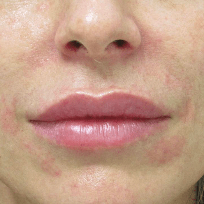 antes aumento de labios