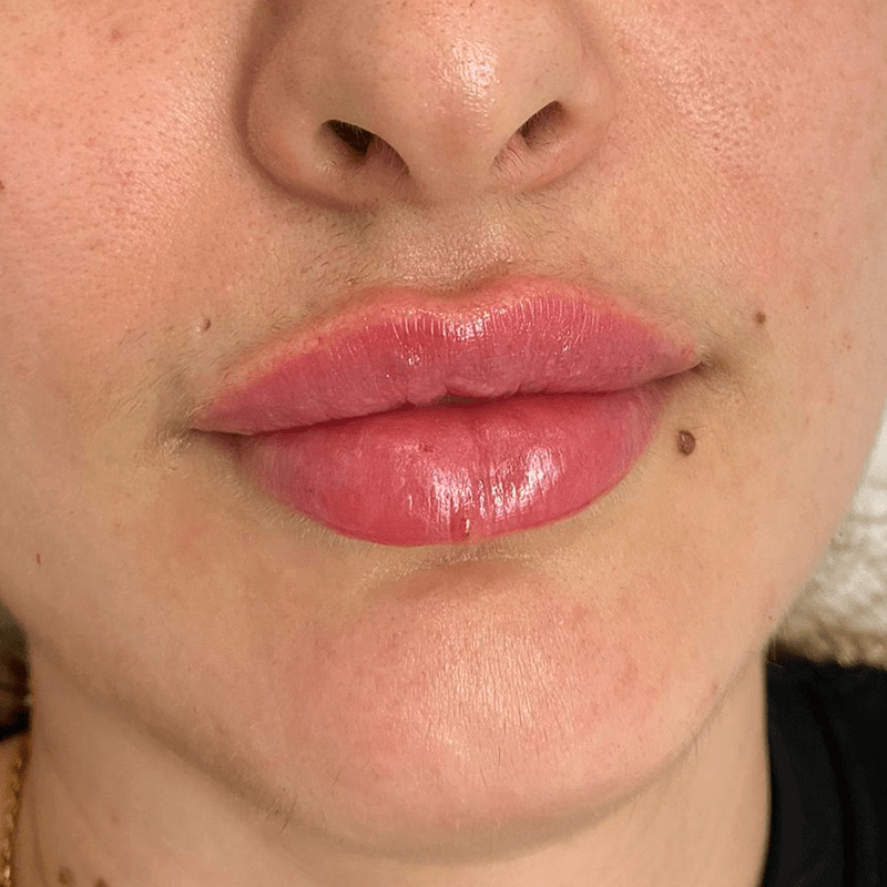 despues labios aumento labios
