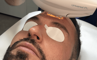 Rejuvenecimiento facial IPL