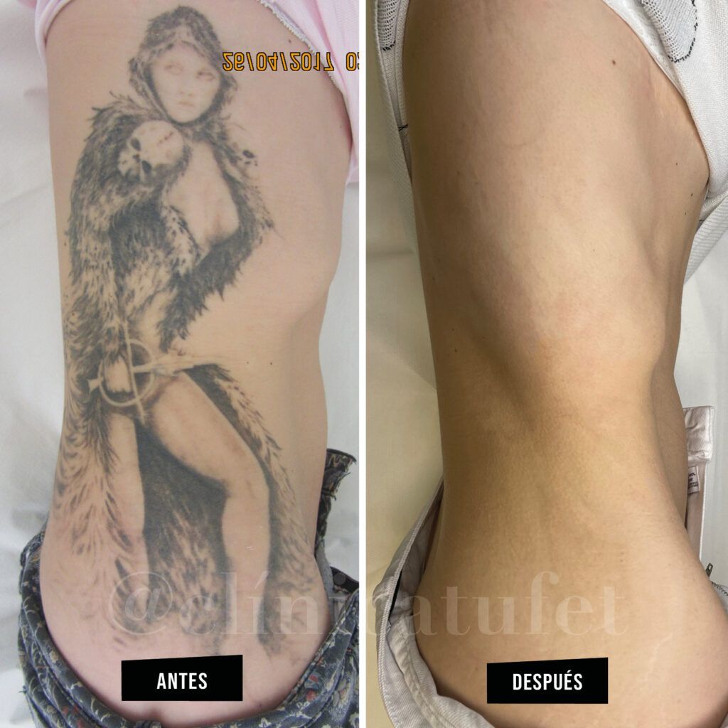 como eliminar un tatuaje de la piel
