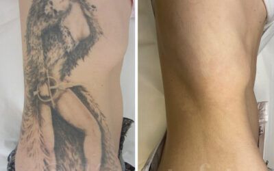 Eliminación de tatuajes con láser