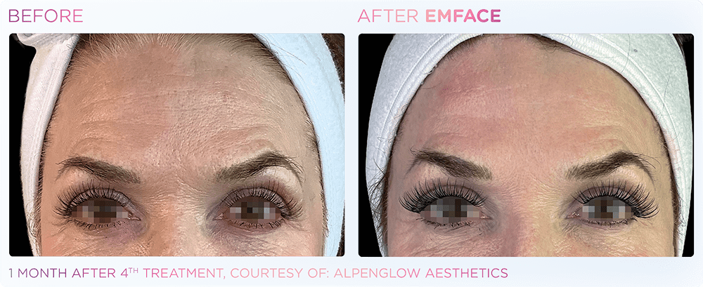 emface flacidez facial elevación de cejas