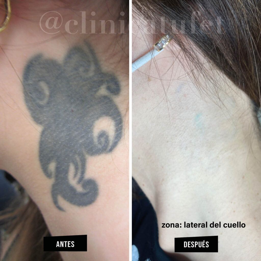 laser tattoo removal