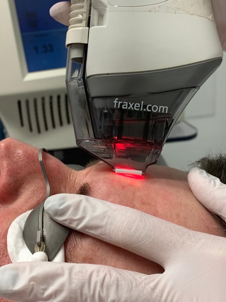 laser fraxel laser textura piel