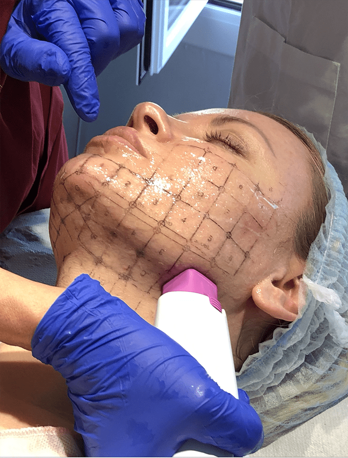 thermage flx clinica tufet madrid