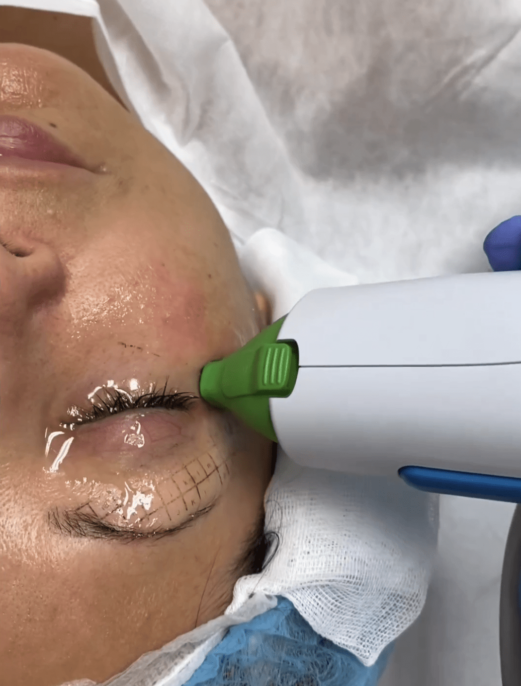 thermage flx dr tufet madrid