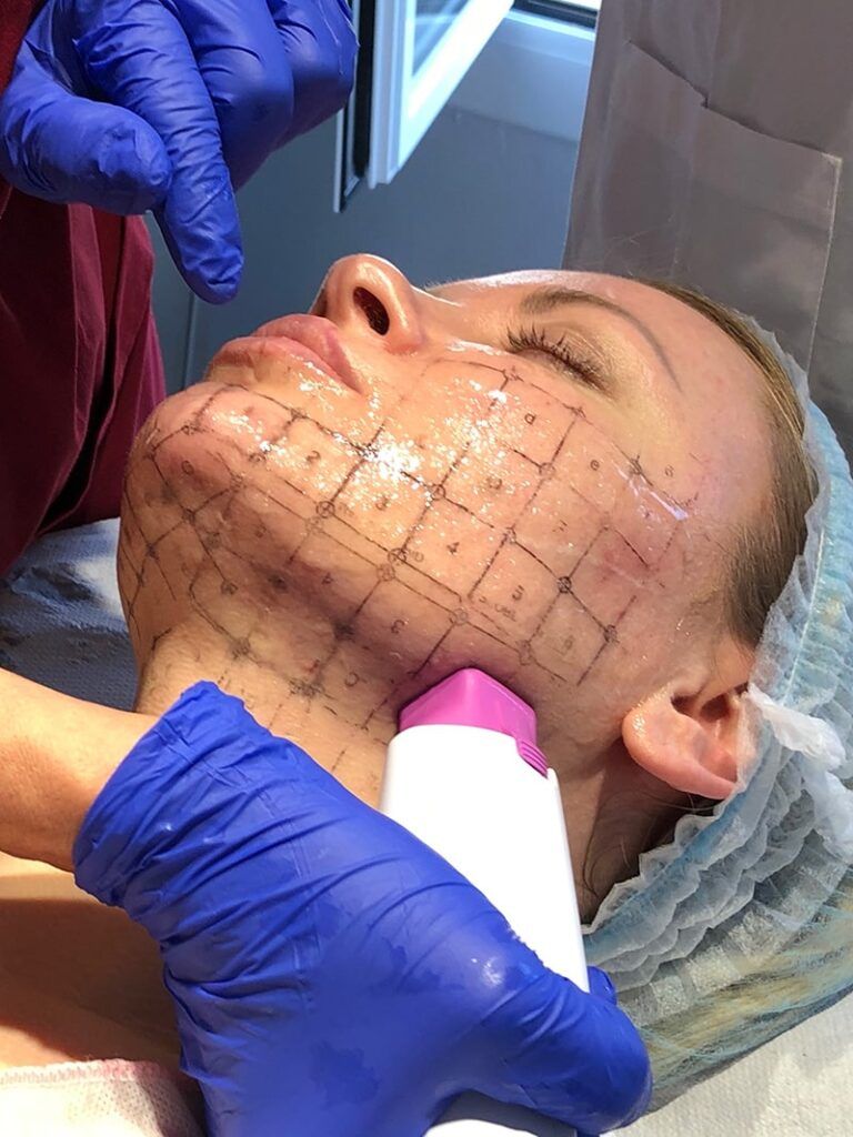 facelift without surgery thermageflx
