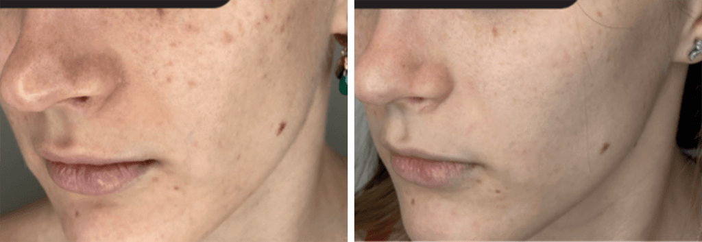 Retinol and antioxidant treatments