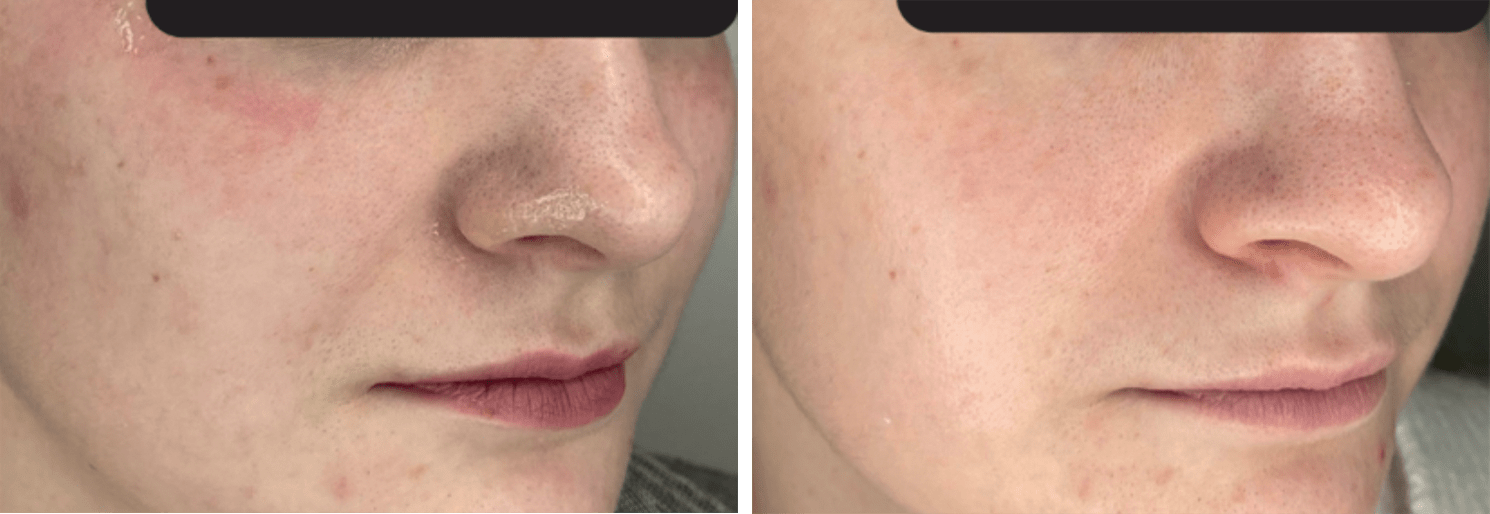 smart dna therapy clinica tufet peeling químico barcelona